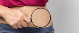 1105073645 - How to get rid of stretch marks
