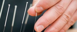 Acupuncture for weight loss