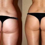 Will cellulite disappear after losing weight? Common mistakes and prevention 