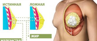 Treatment of gynecomastia