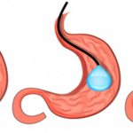 Treatment of obesity using gastric ballooning