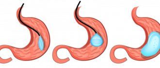 Treatment of obesity using gastric ballooning