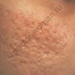 Consequences of acne and methods of its treatment