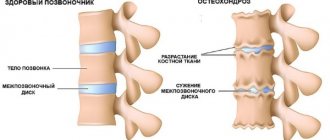 With osteochondrosis, irreversible changes occur in the spine