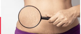 Causes of postpartum belly