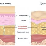 Causes of cellulite, treatment methods using VASER, Thermage and Z Wave devices
