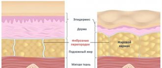 Causes of cellulite, treatment methods using VASER, Thermage and Z Wave devices