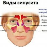 Синусит вызывает заложенность носа
