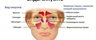 Sinusitis causes nasal congestion