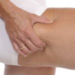 Stages of cellulite