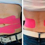 Kinesiotherapy techniques for diastasis of the rectus abdominis muscles