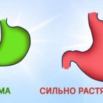 Stomach reduction